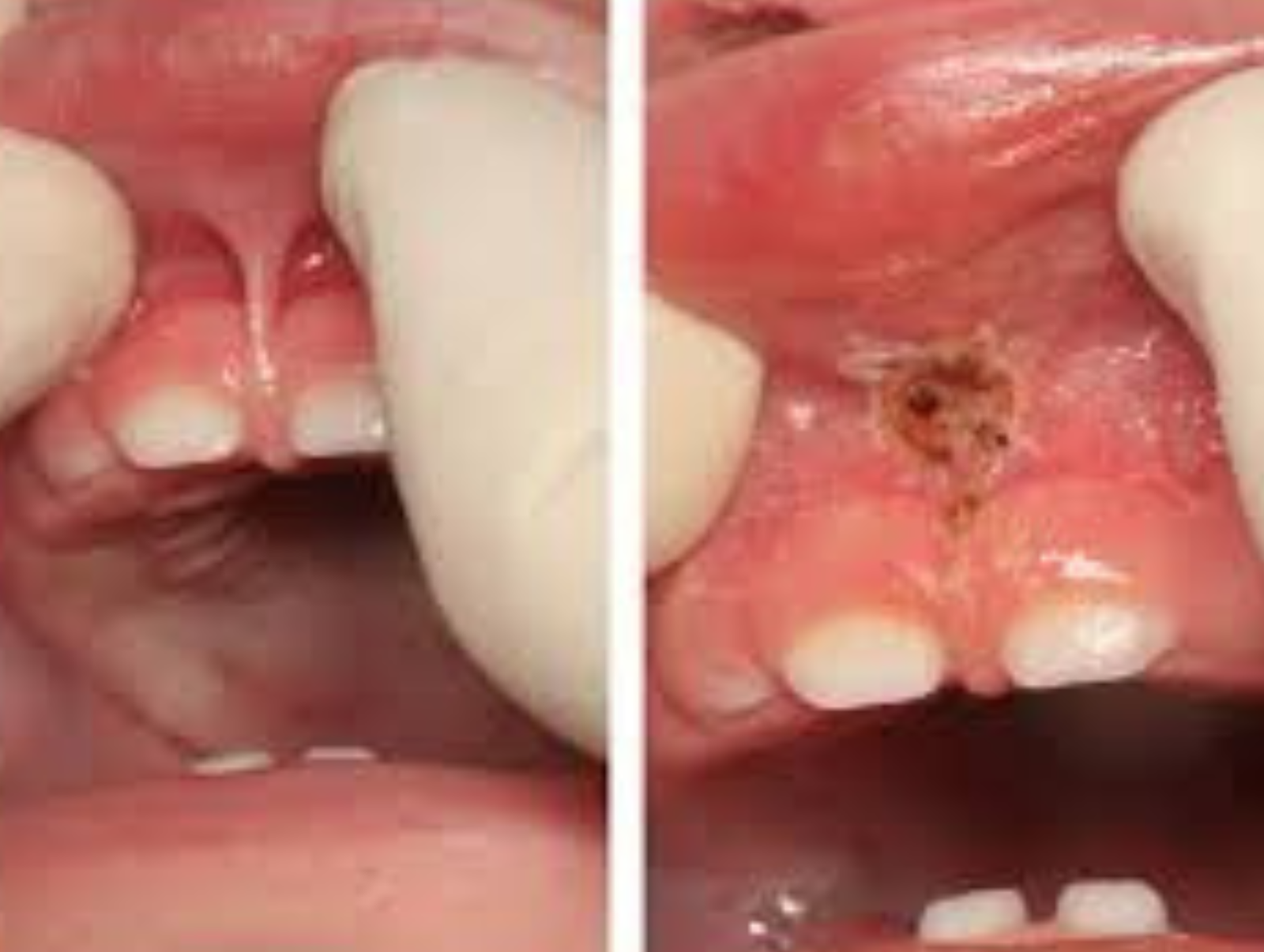 Frenectomy