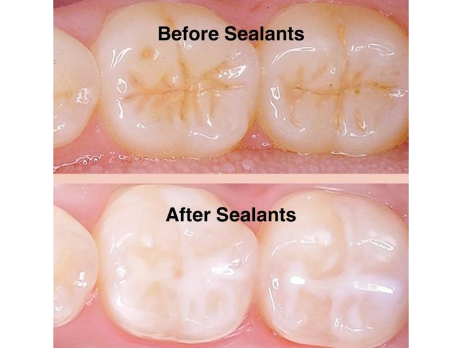 Sealants