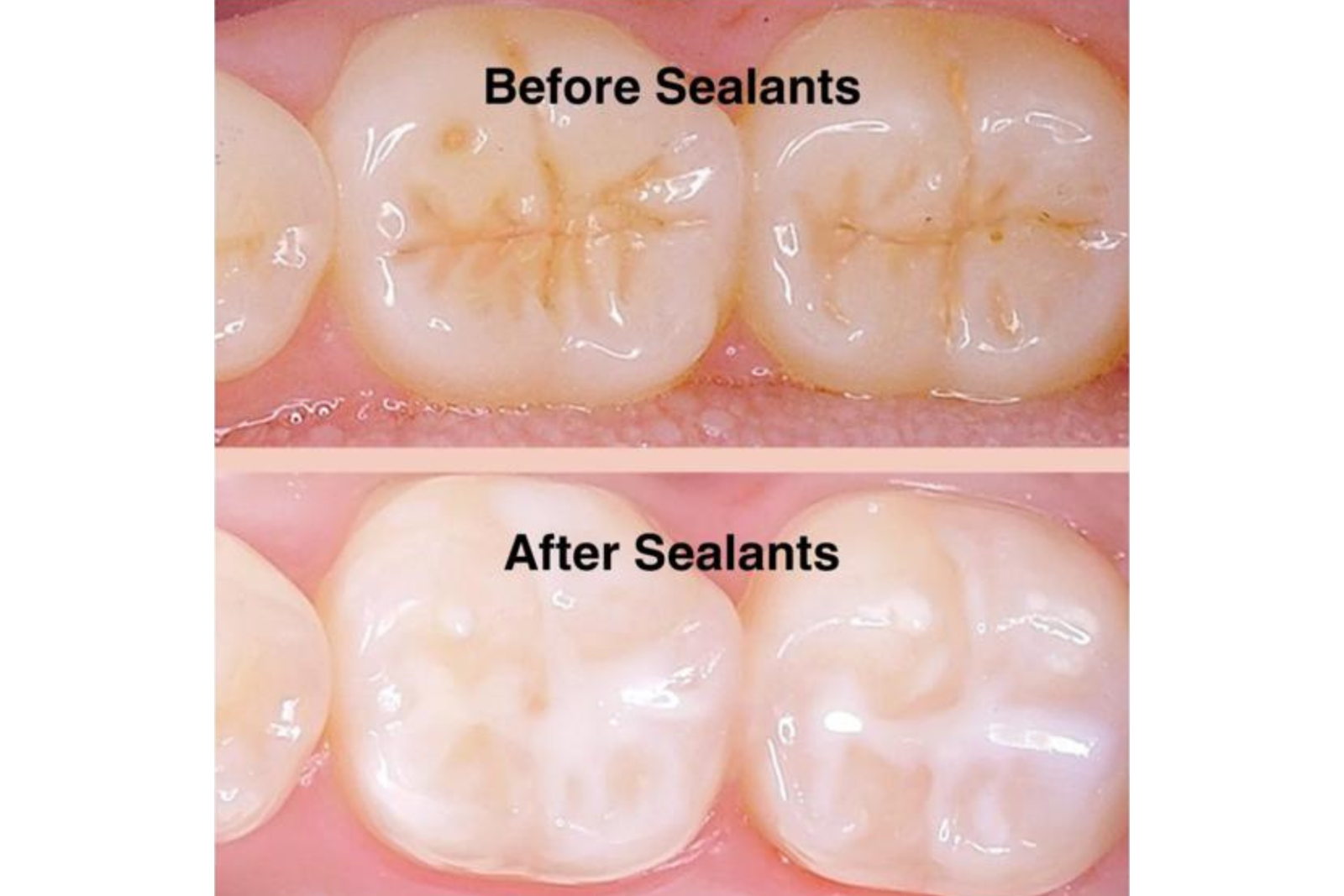 Sealants Sealants