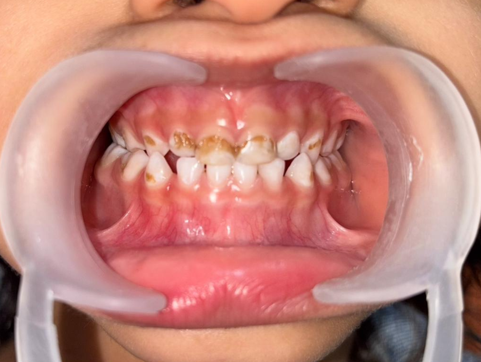 Early Childhood Caries