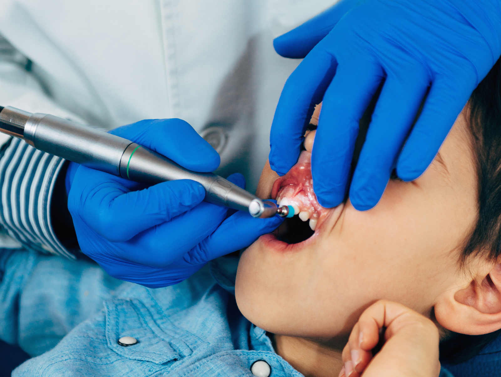 Fluoride Treatment