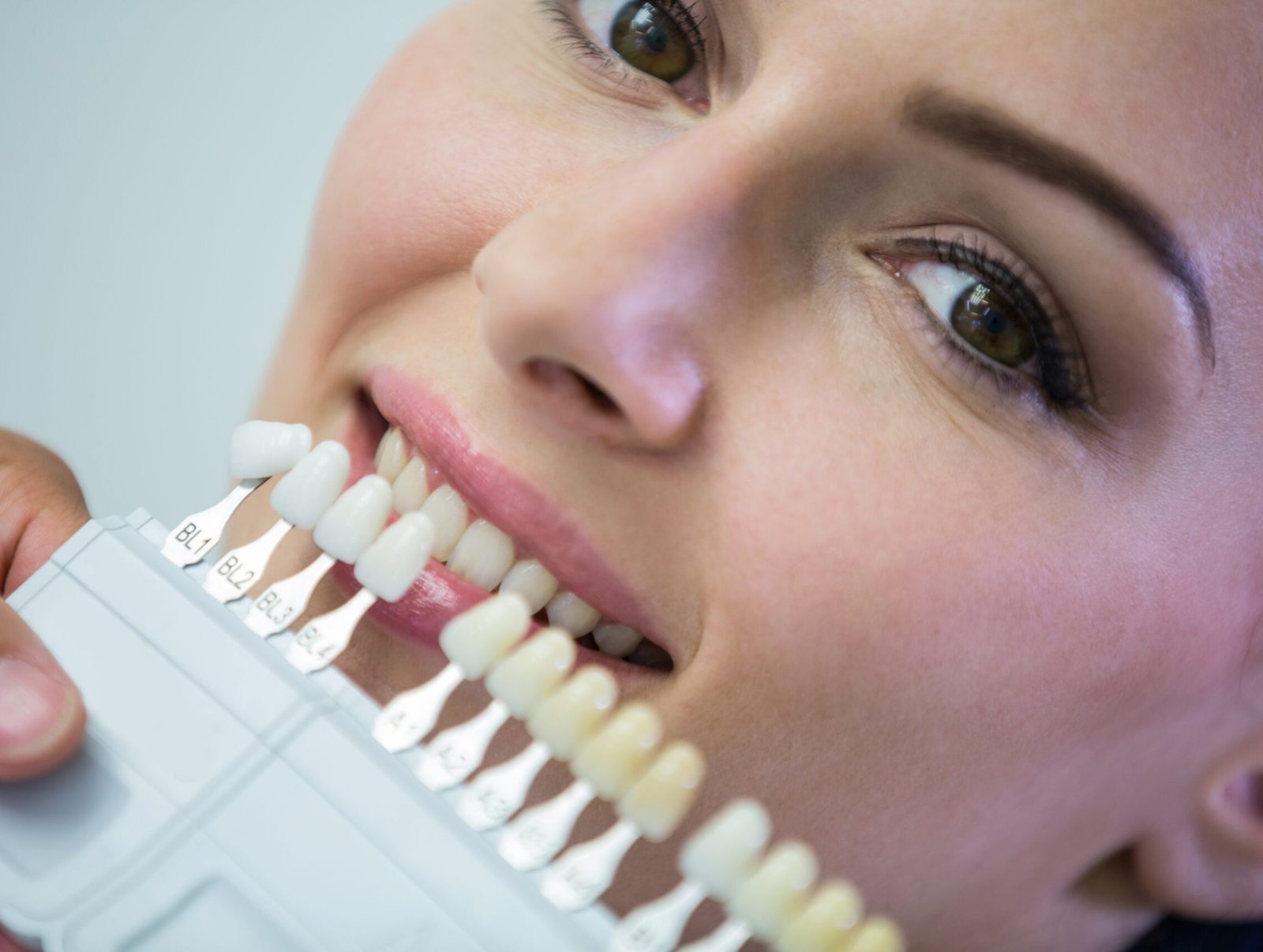 Tooth Coloured Fillings