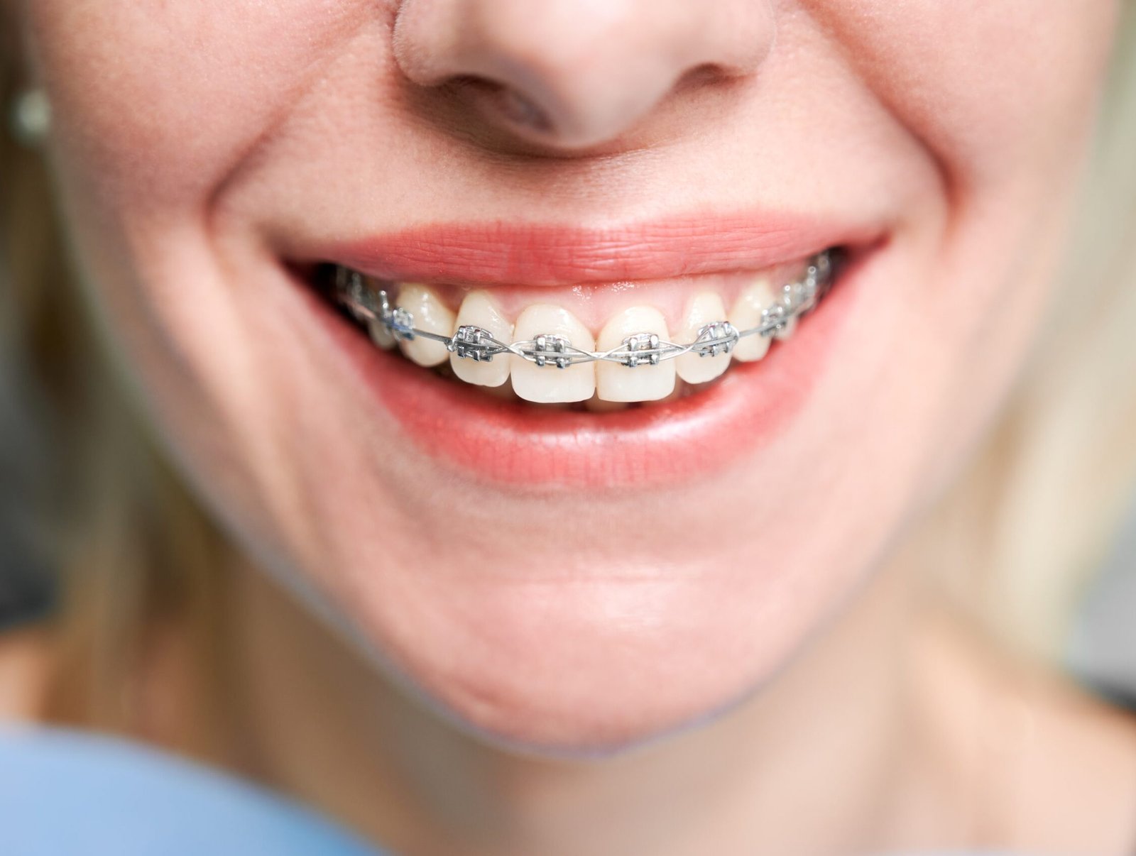 Braces