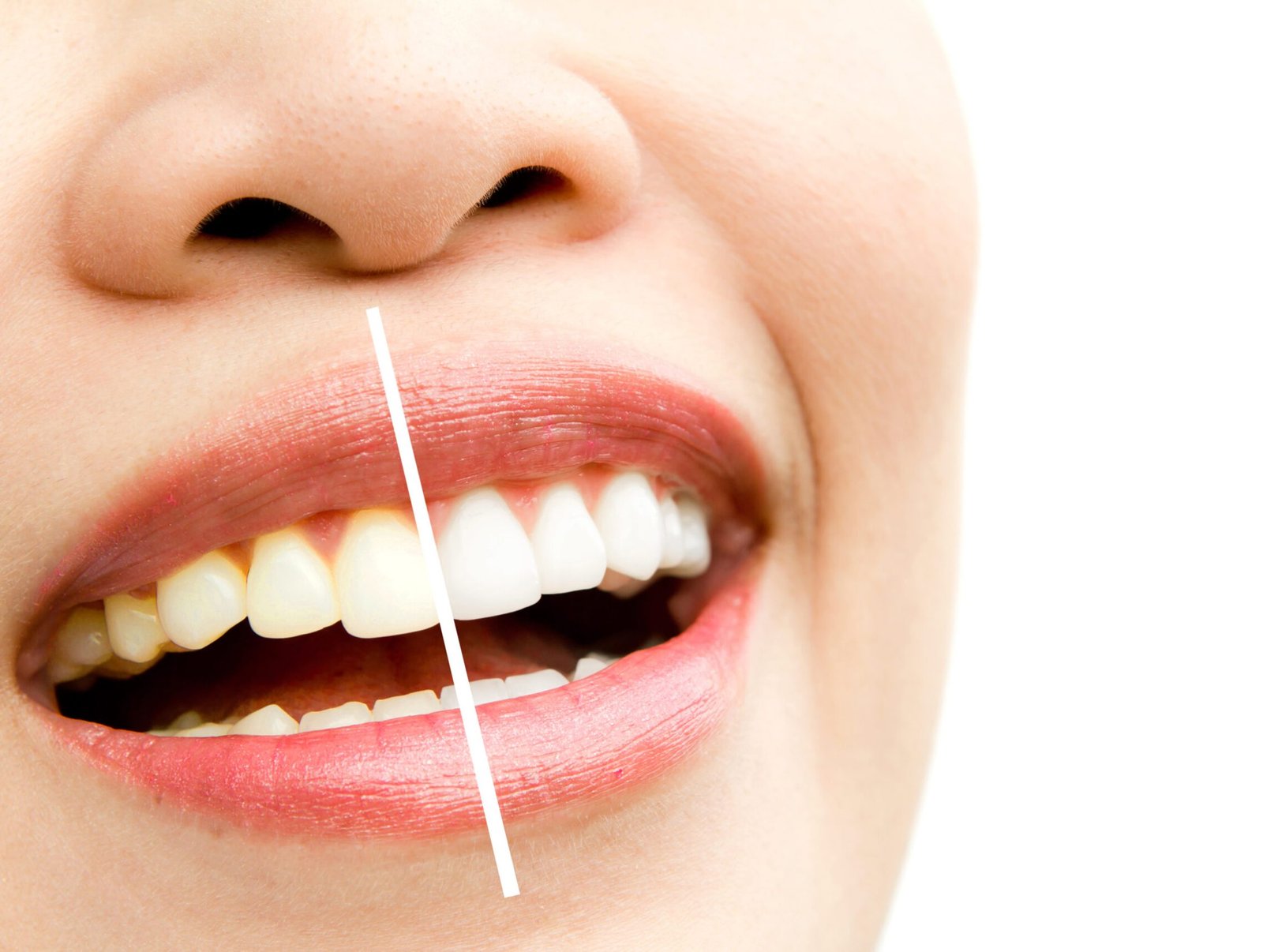 Teeth Cleaning and Whitening